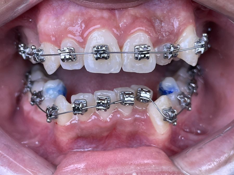 Aparelho ortodôntico fixo, com braquetes metálicos e fio colados aos dentes