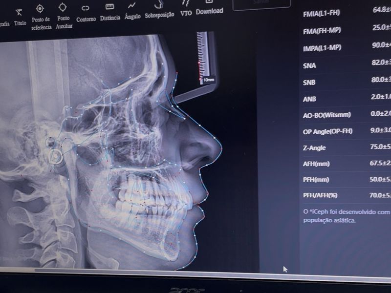 Tela do computador com uma telerradiografia de perfil e medições da análise